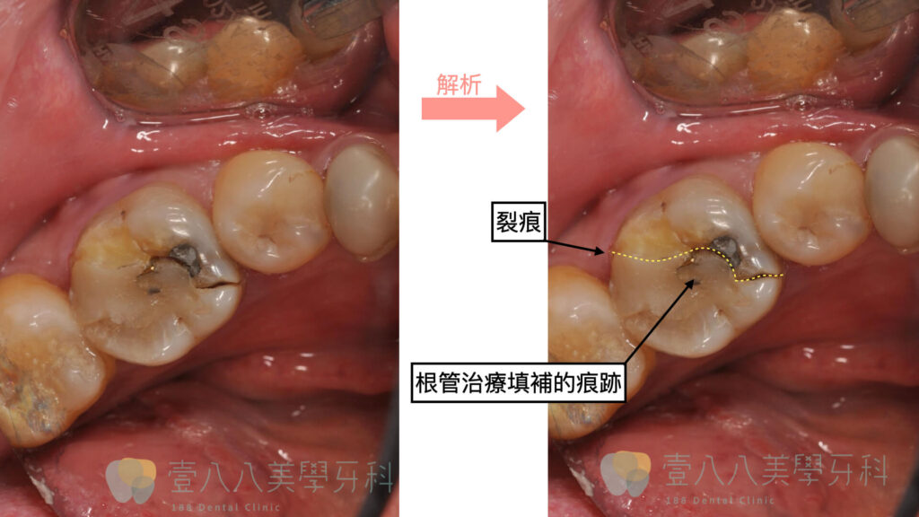 牙裂案例圖01