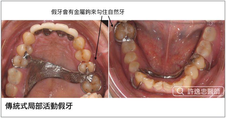 Implant%2bsupported%2boverdenture.005.jpeg