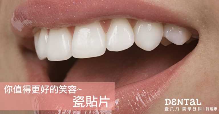 Dental%2bveneer.005.jpeg