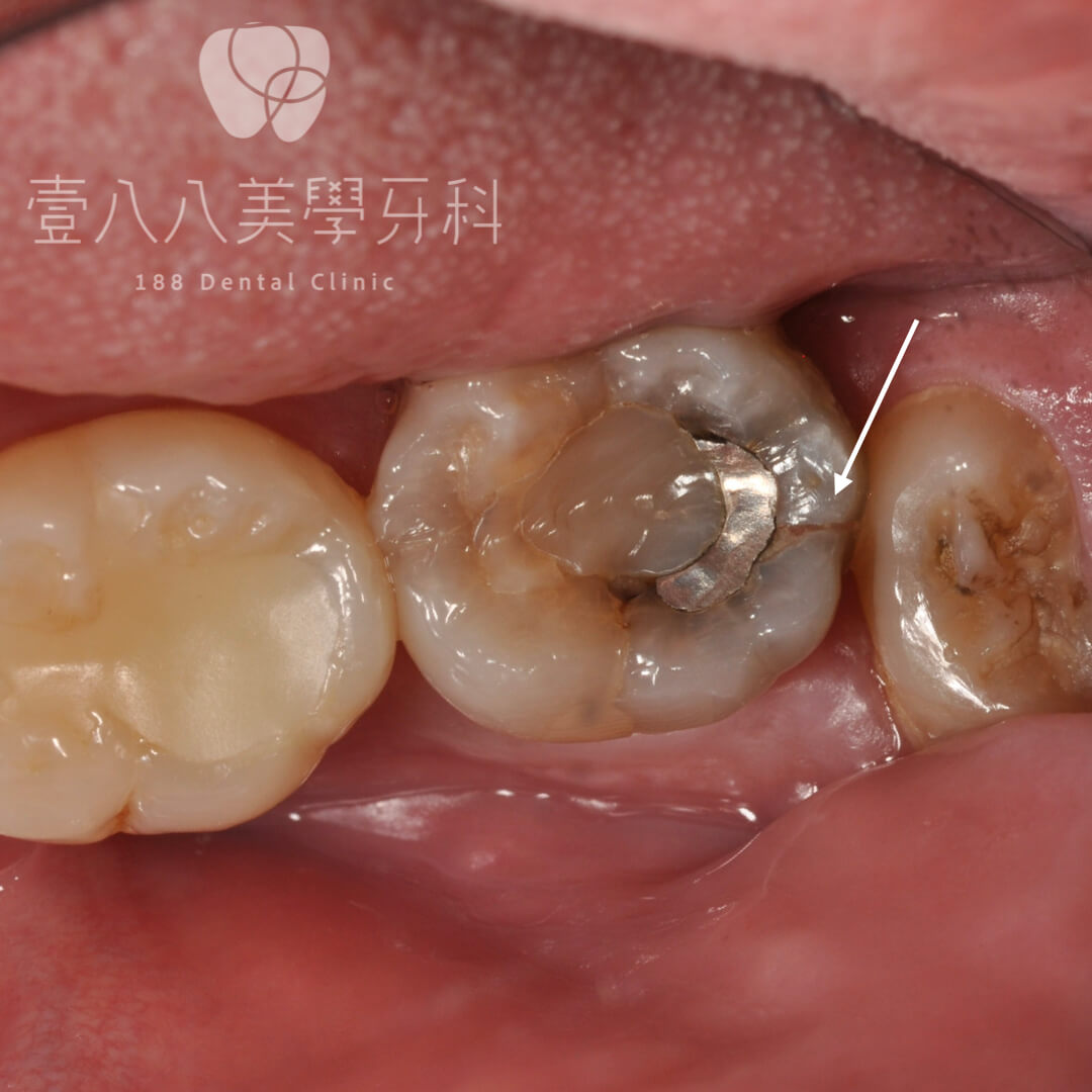 牙齒裂掉.002
