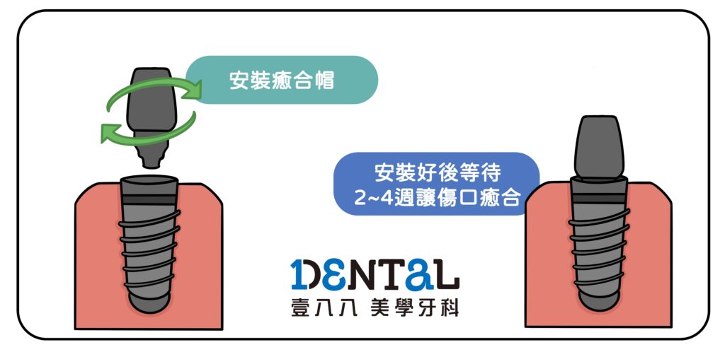 植牙流程-3