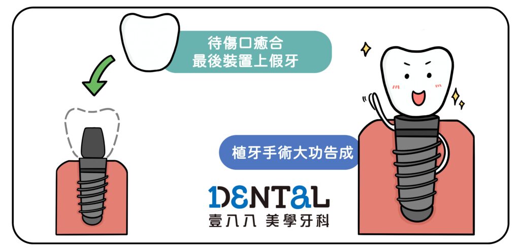 植牙流程-4