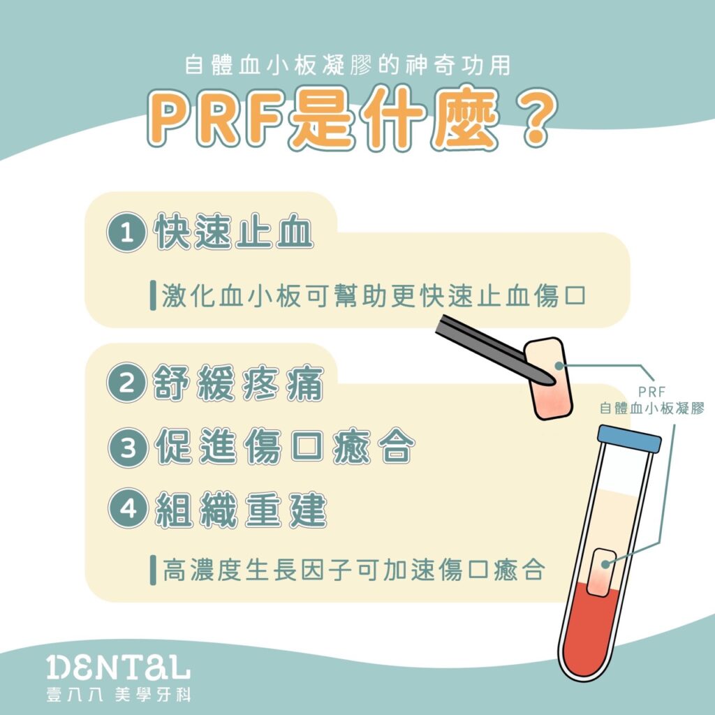 牙科PRF是什麼