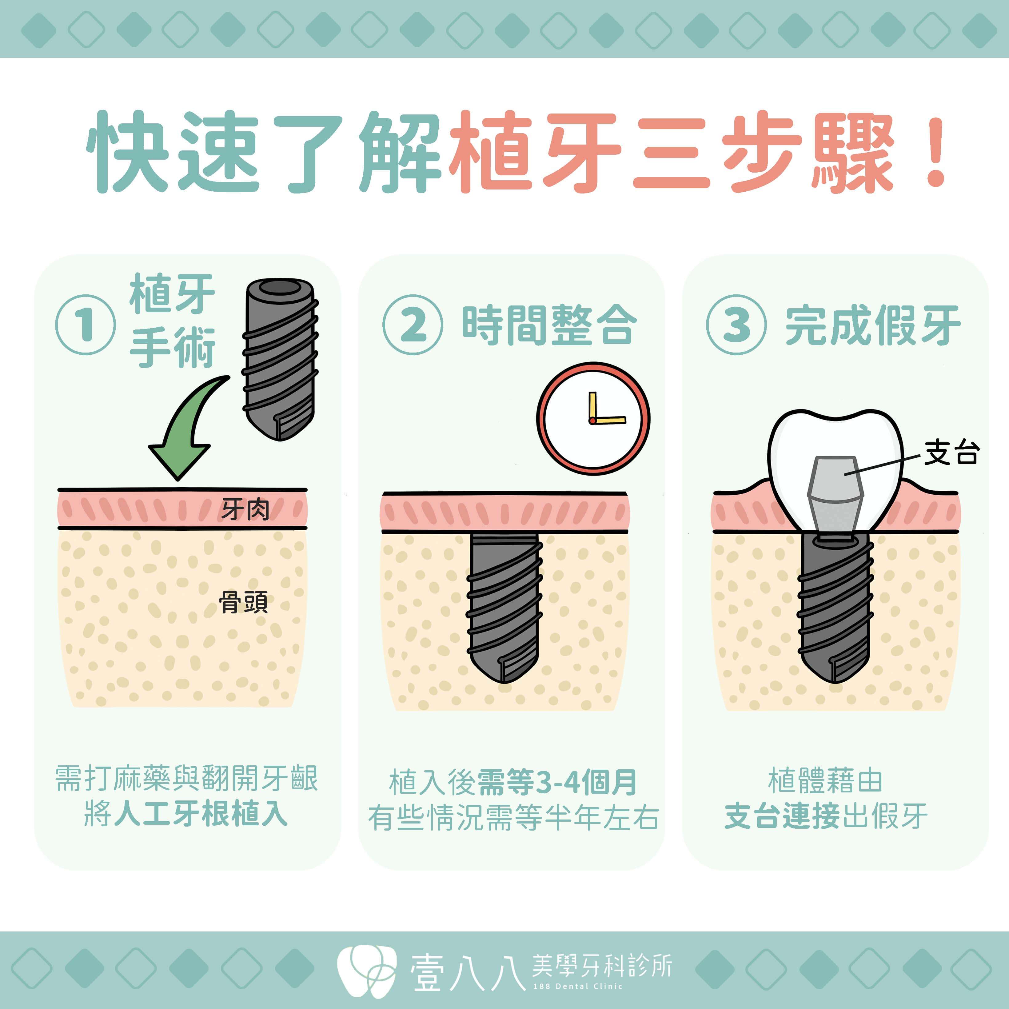 植牙三步驟