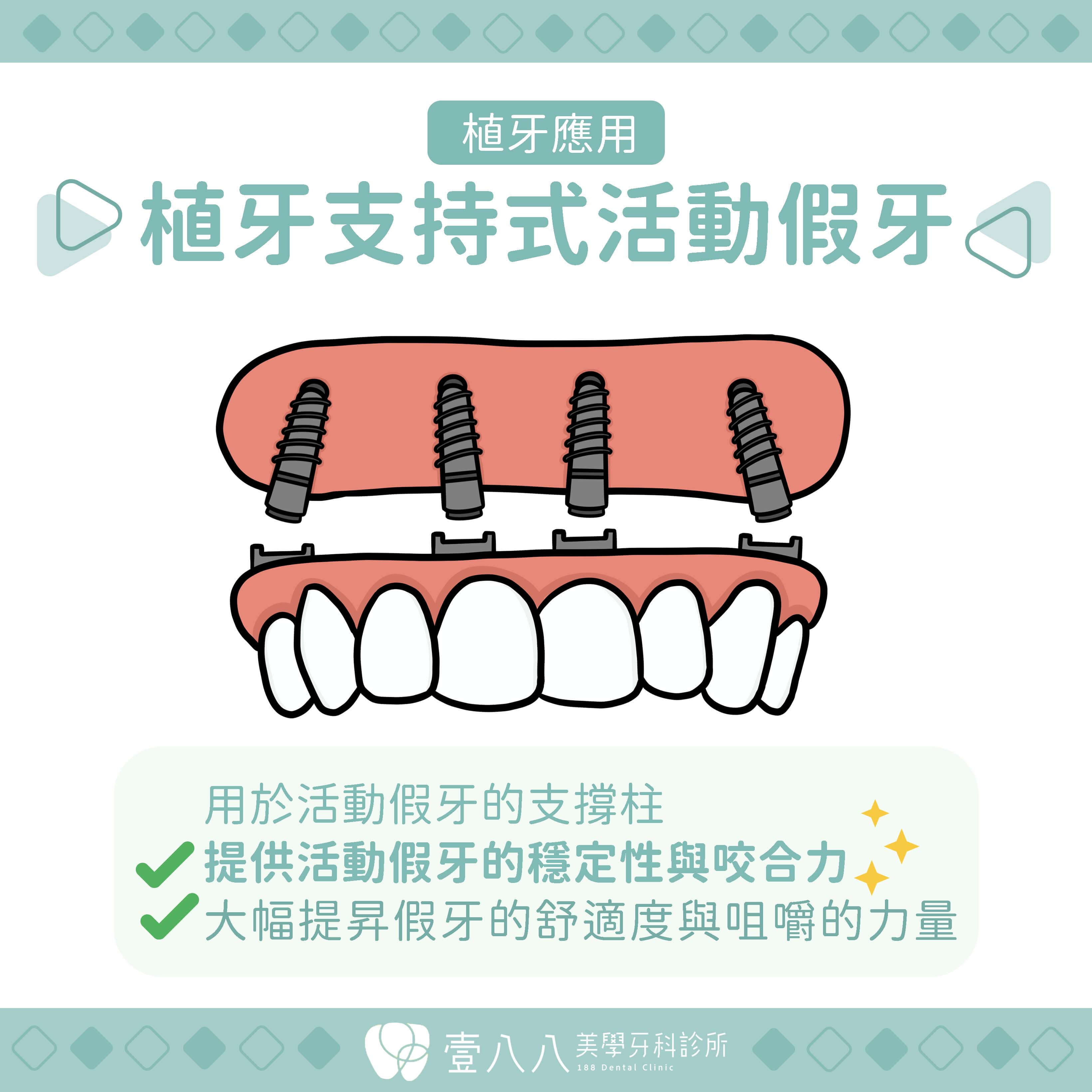 植牙應用 支持式假牙