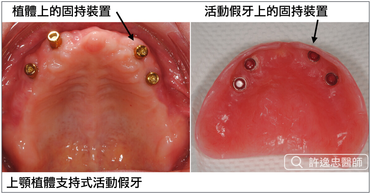 植體支持式活動假牙圖示 (1)