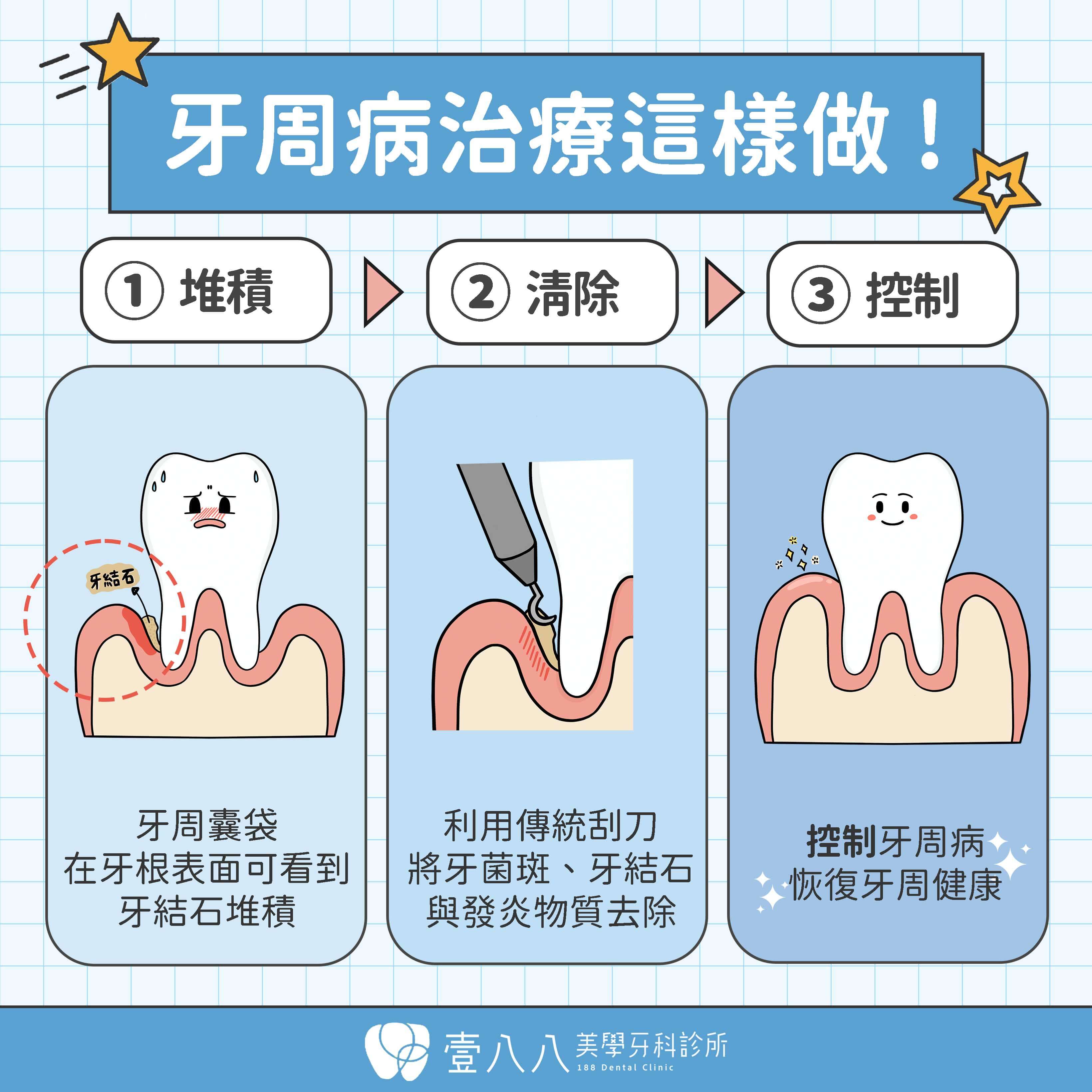 牙周病網頁 傳統牙周治療 deep