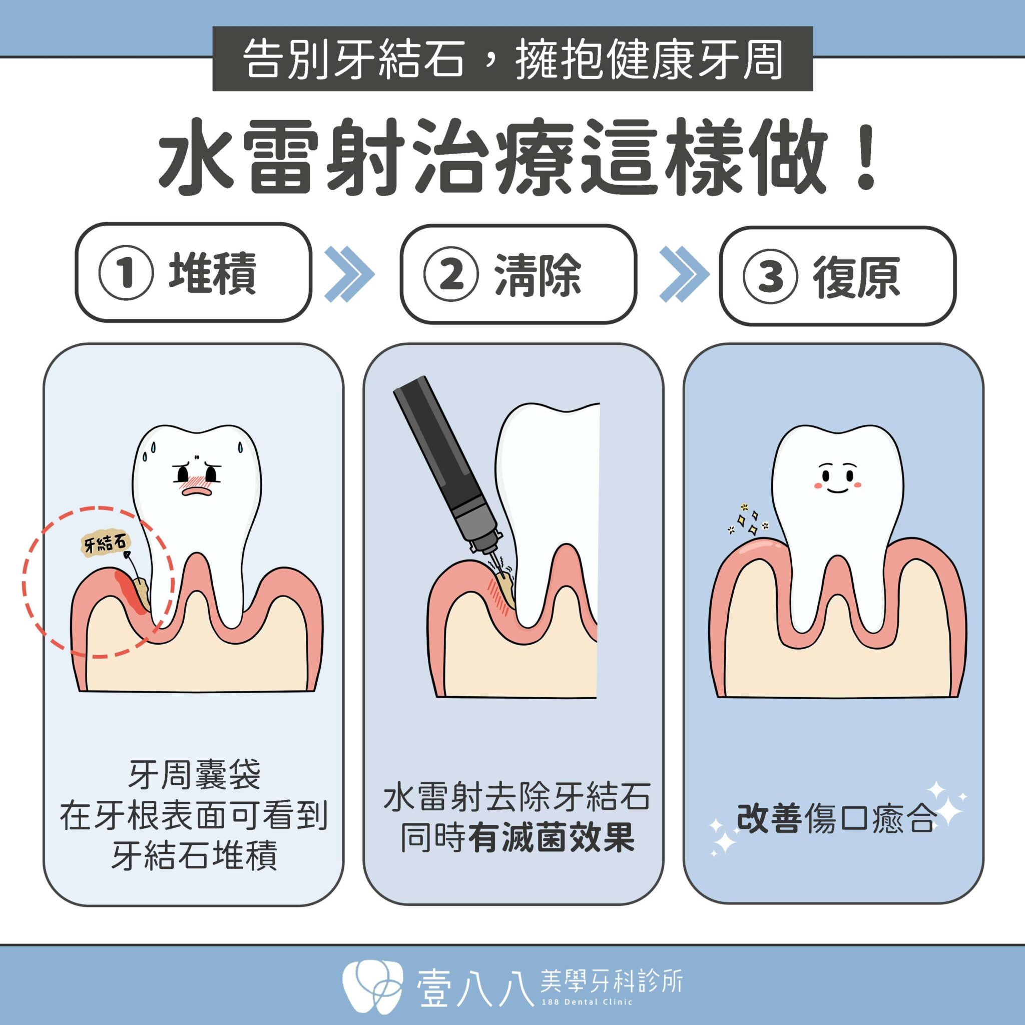 牙周病網頁 水雷射步驟 2048x2048