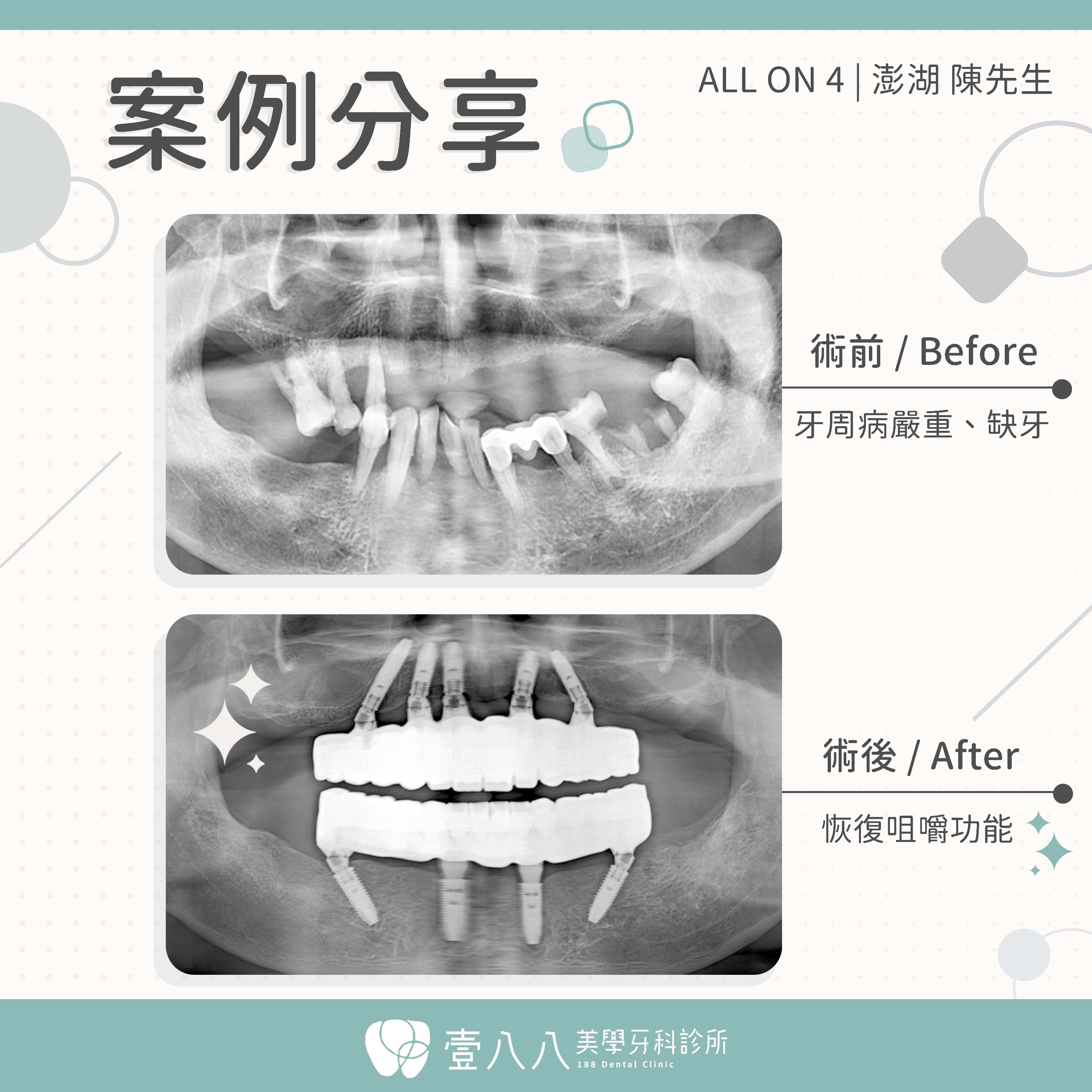 案例32-X光術前術後照