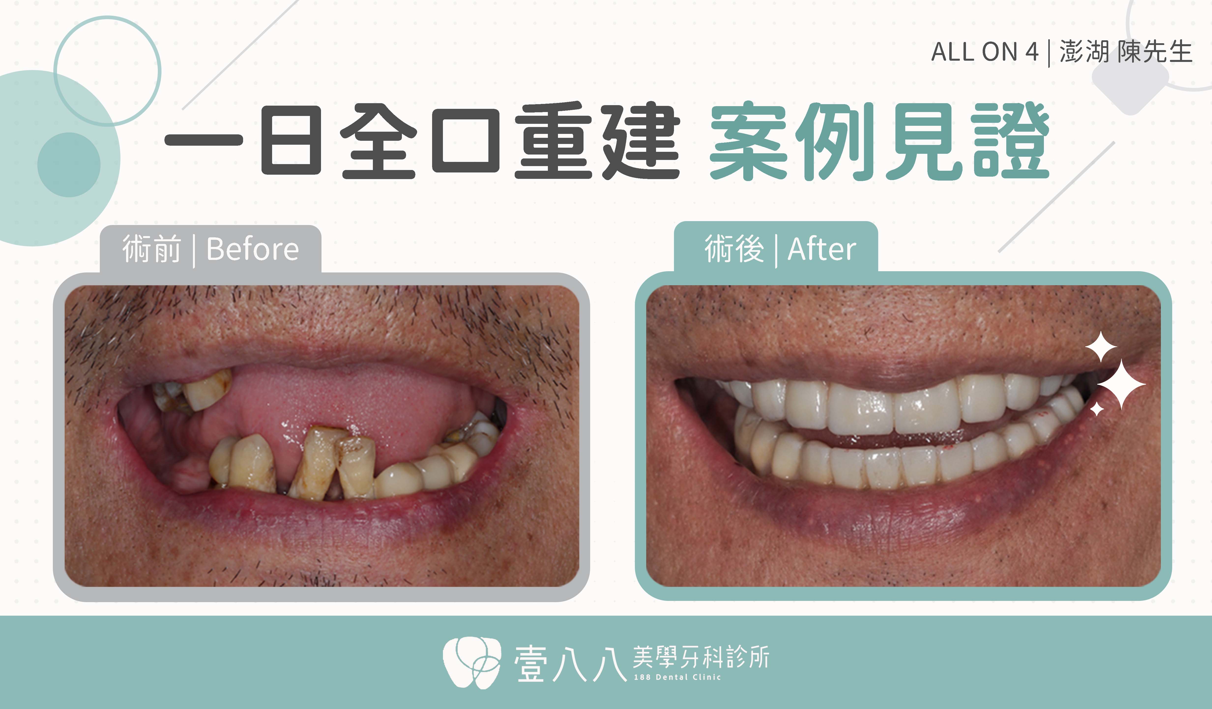 案例32術前述後臨床照-封面