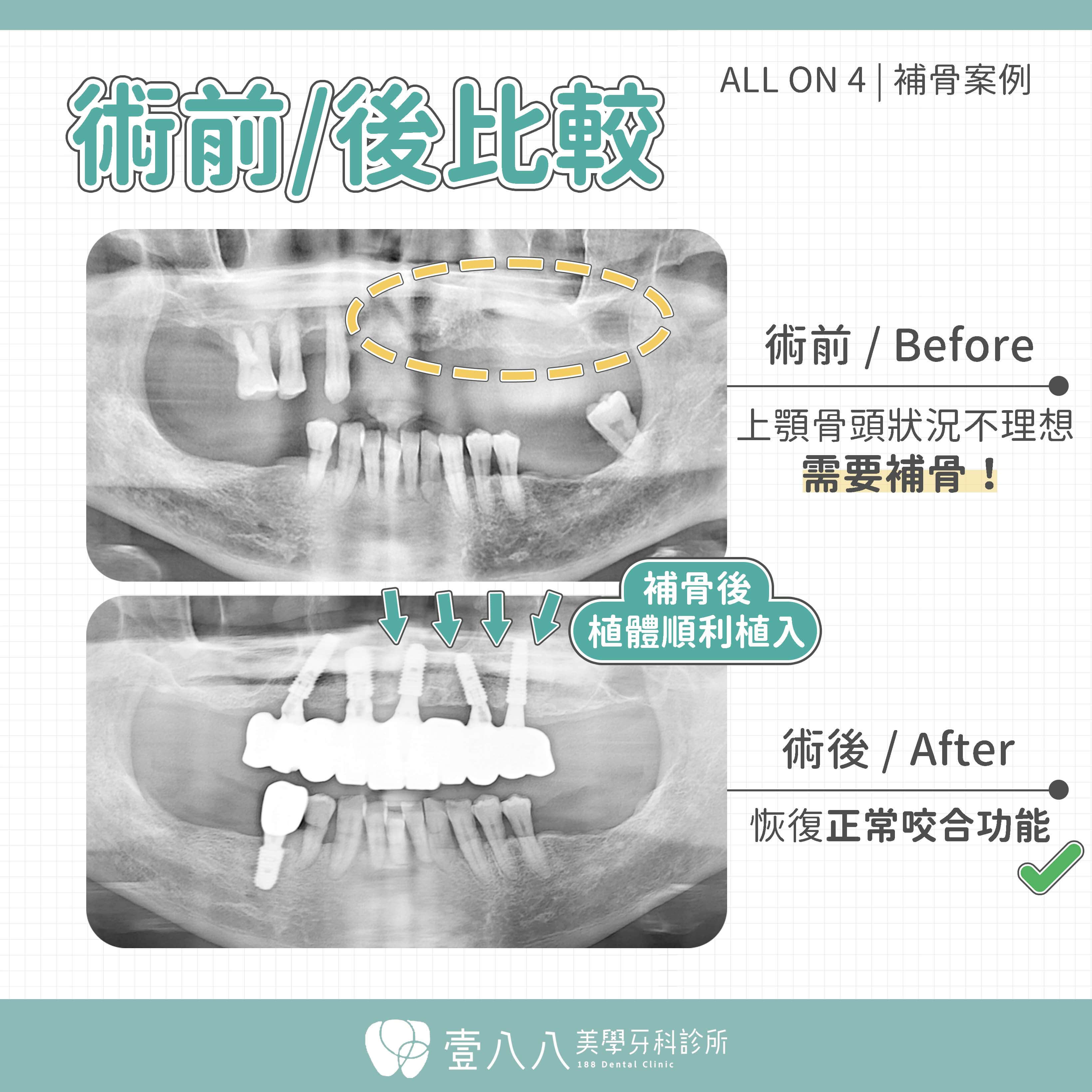 all on 4案例33-術前術後X光照