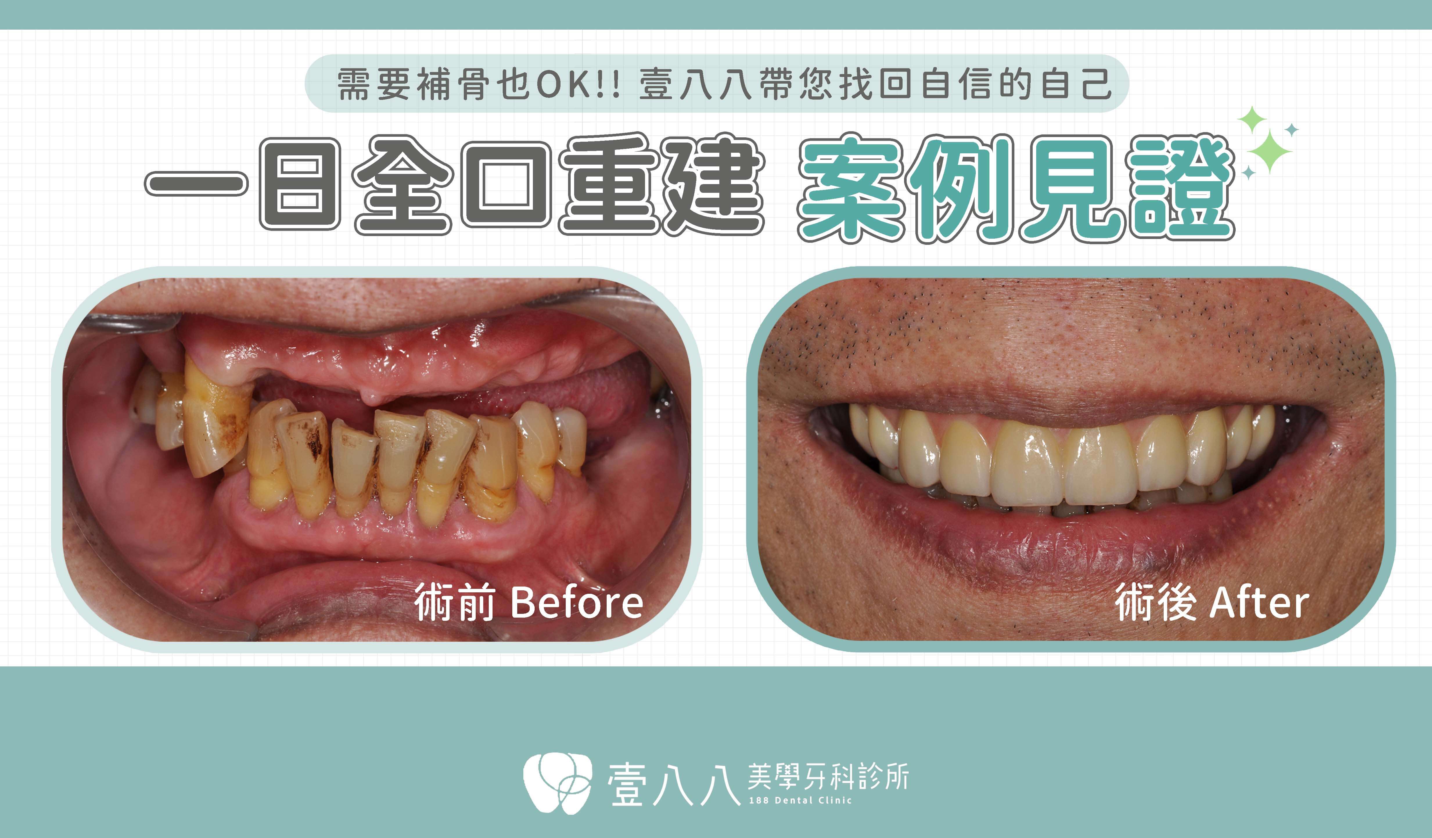 all on 4案例33-術前術後照