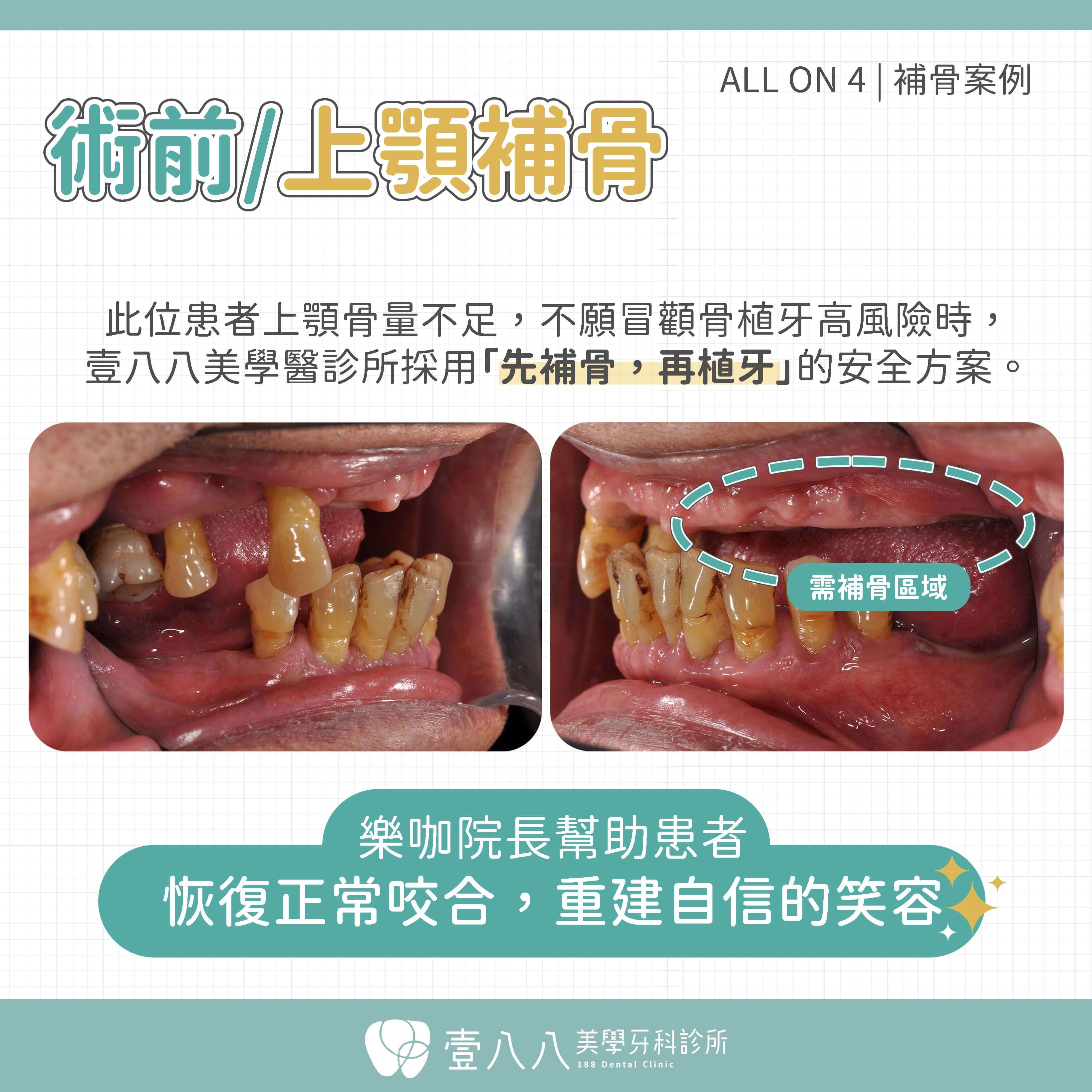 all on 4案例33-術前臨床照