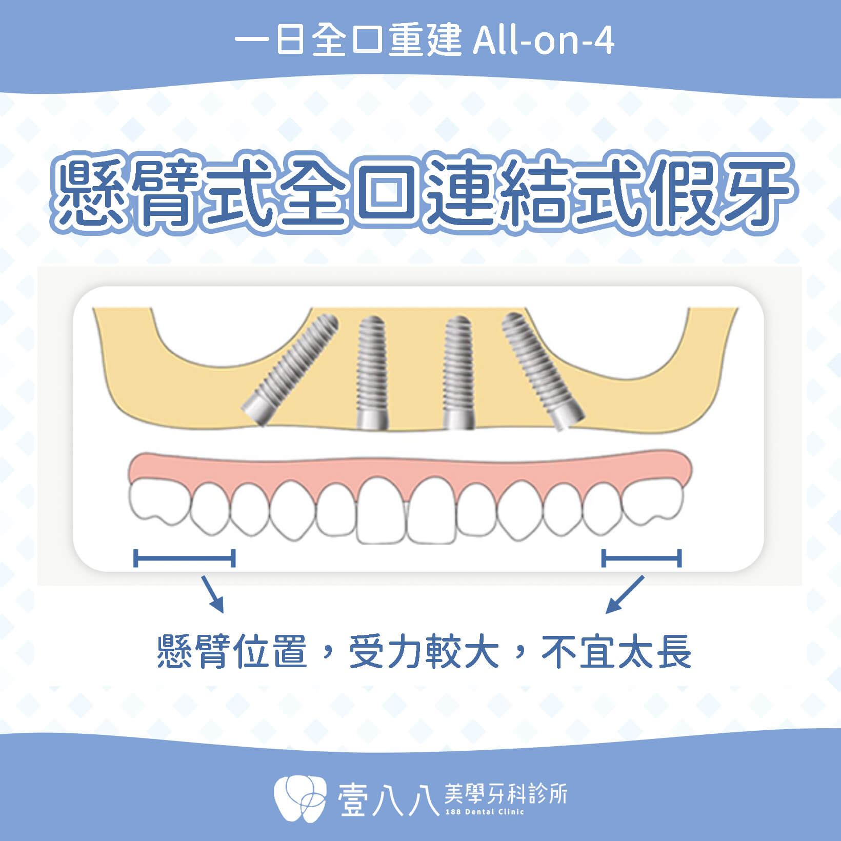 all on 4九大併發症-all on 4假牙示意圖