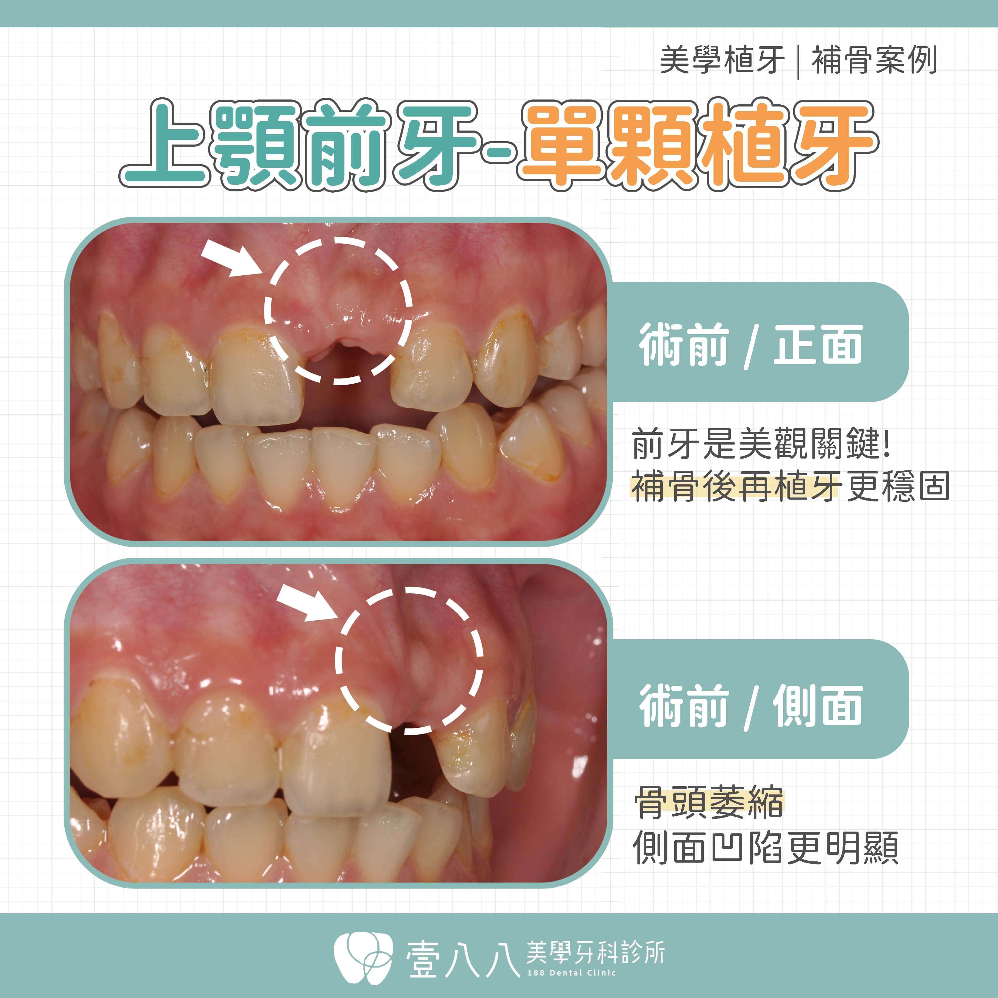 前牙植牙案例 案例34 手術前
