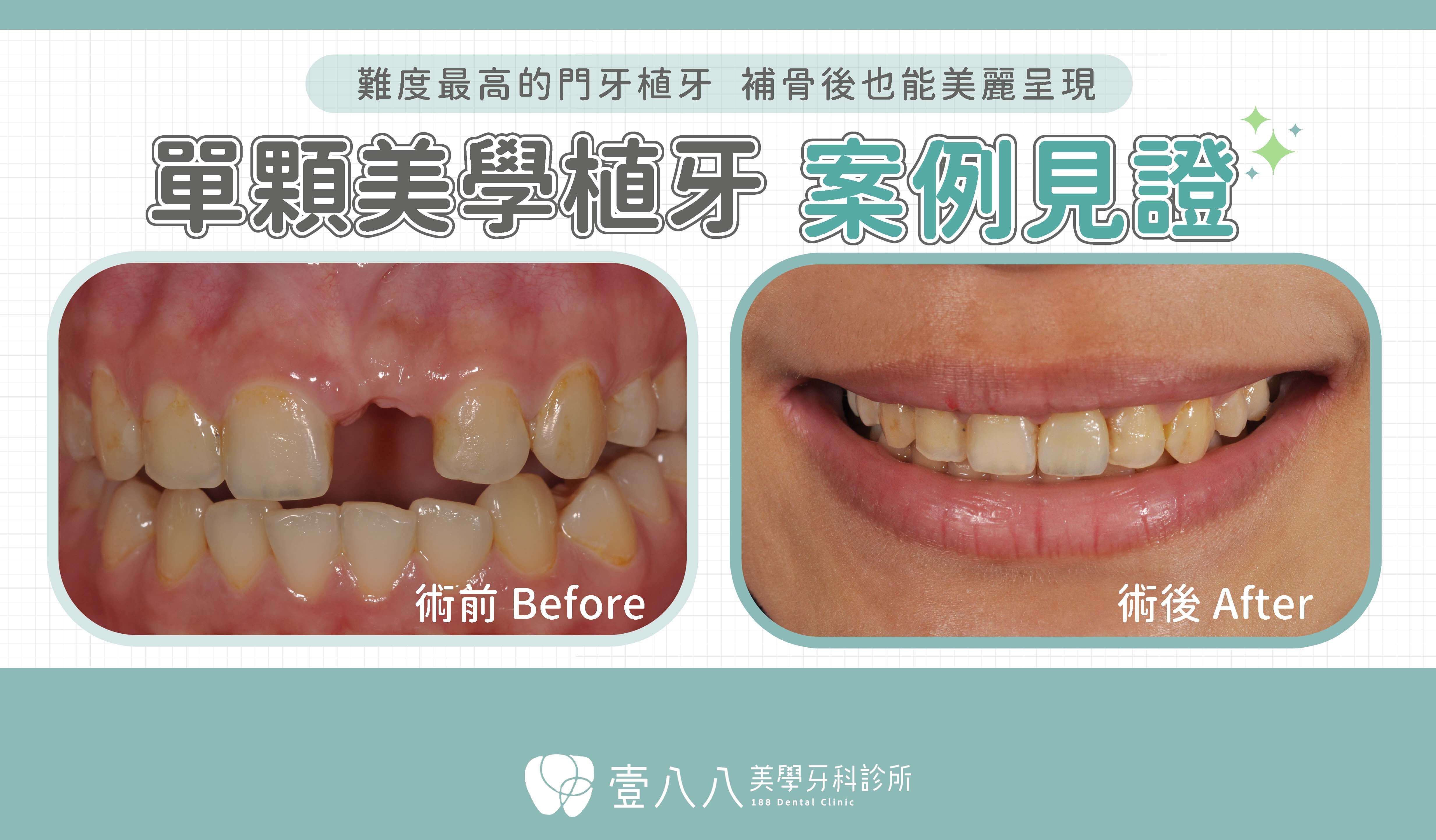 前牙植牙案例 案例34 術前術後