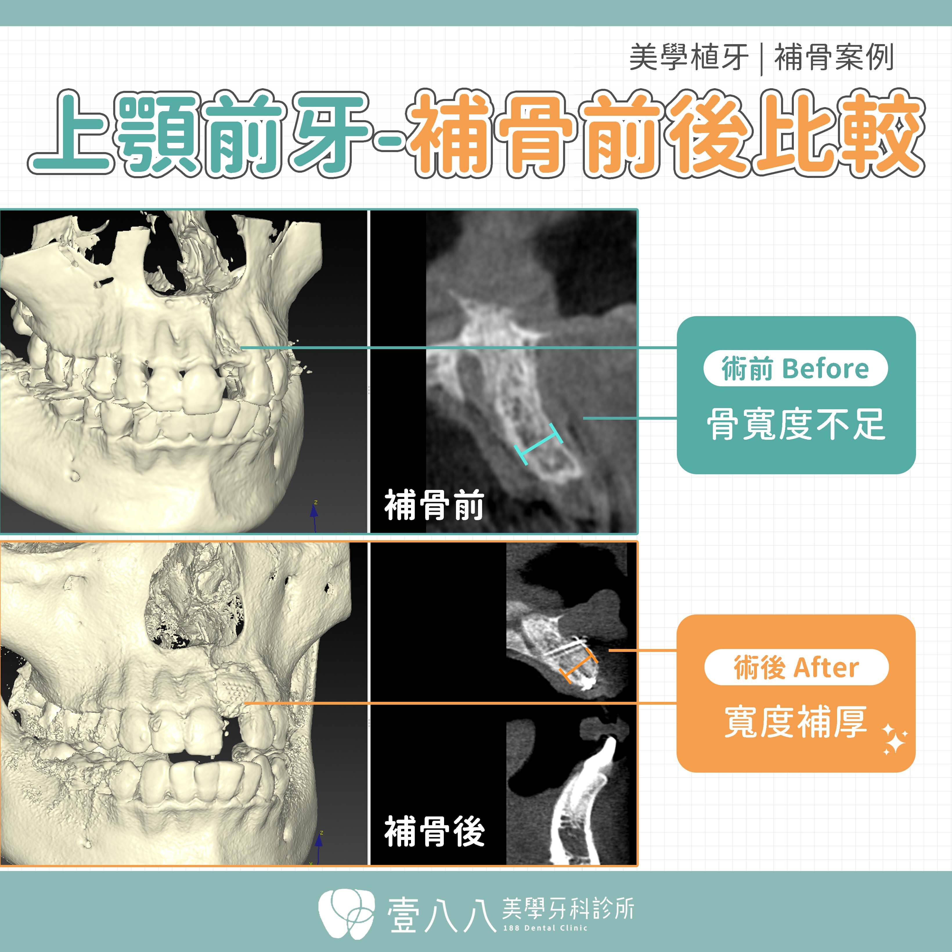 前牙植牙案例 案例34 補骨前後比較