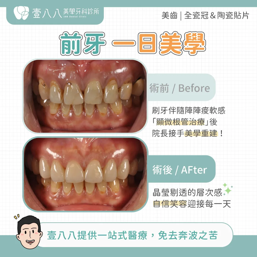 一日美齒貼片，術前與術後比較