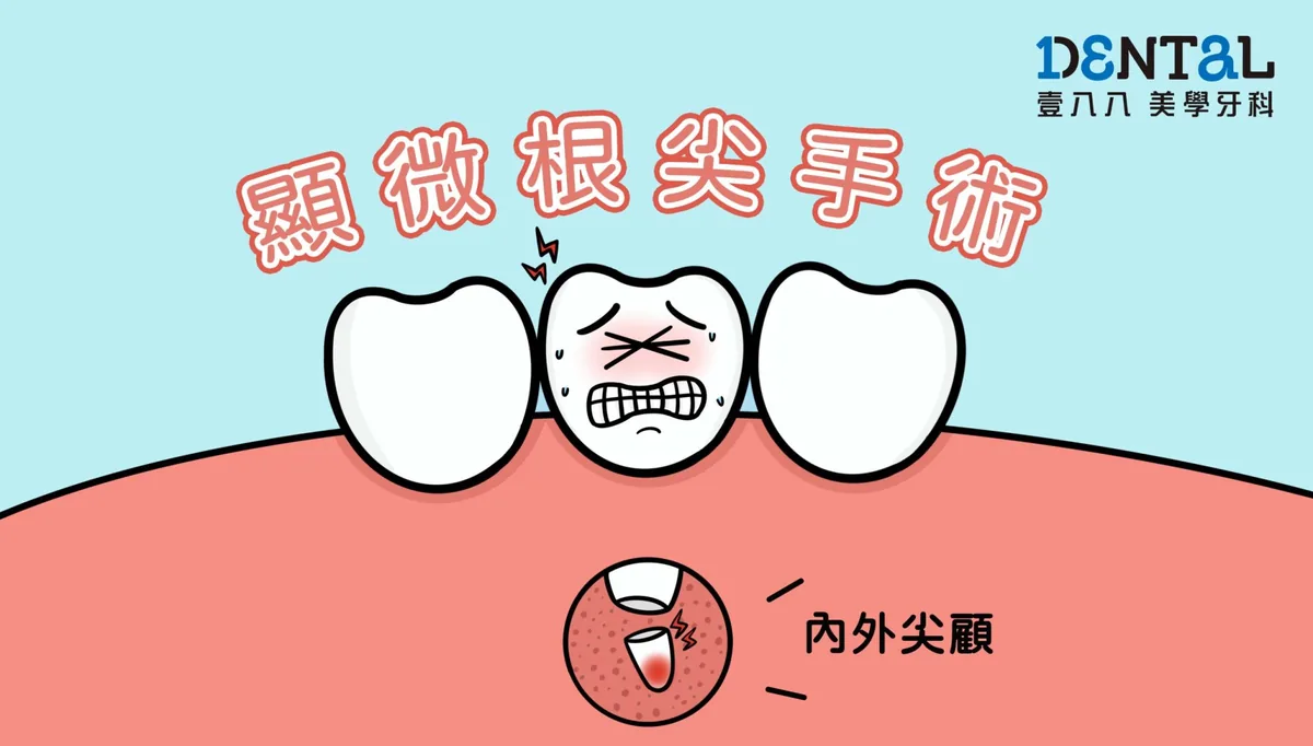 根尖手術與顯微根管治療衛教文章封面