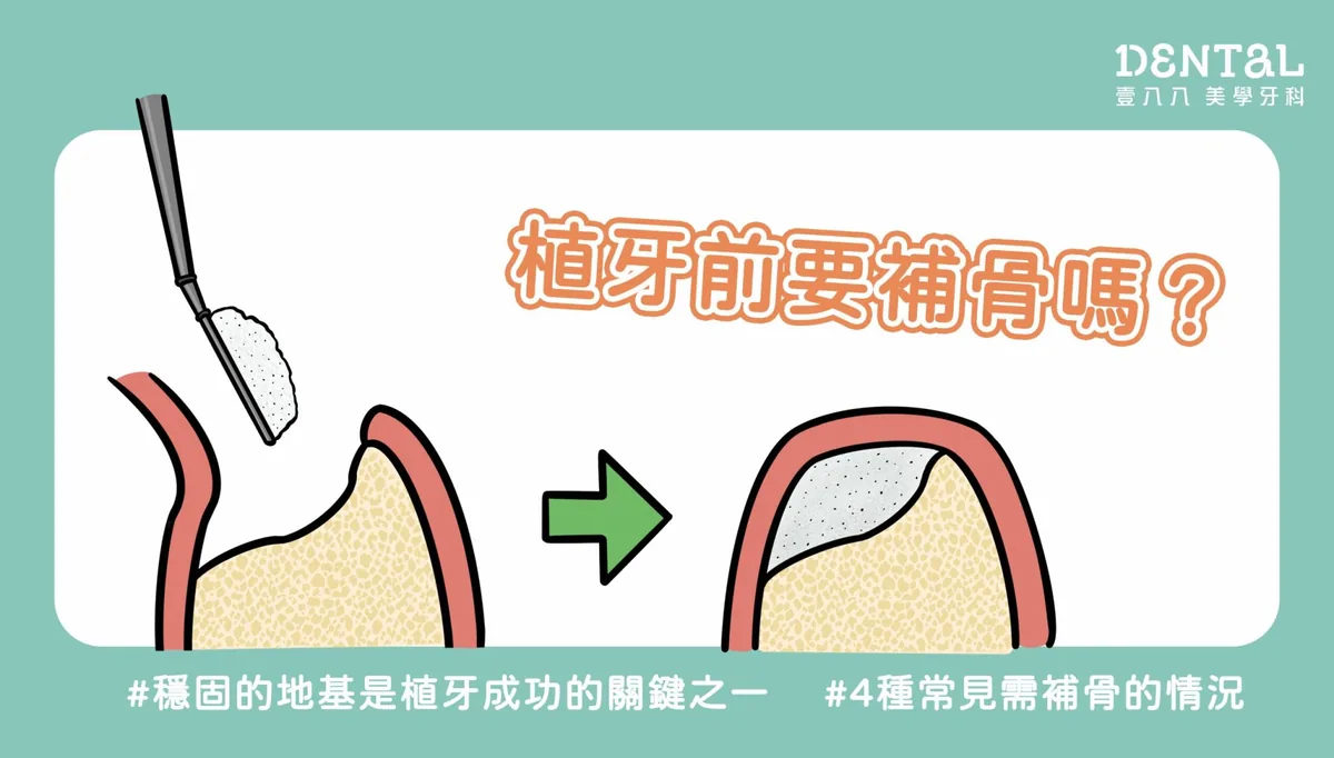 為什麼植牙要補骨？衛教文章封面